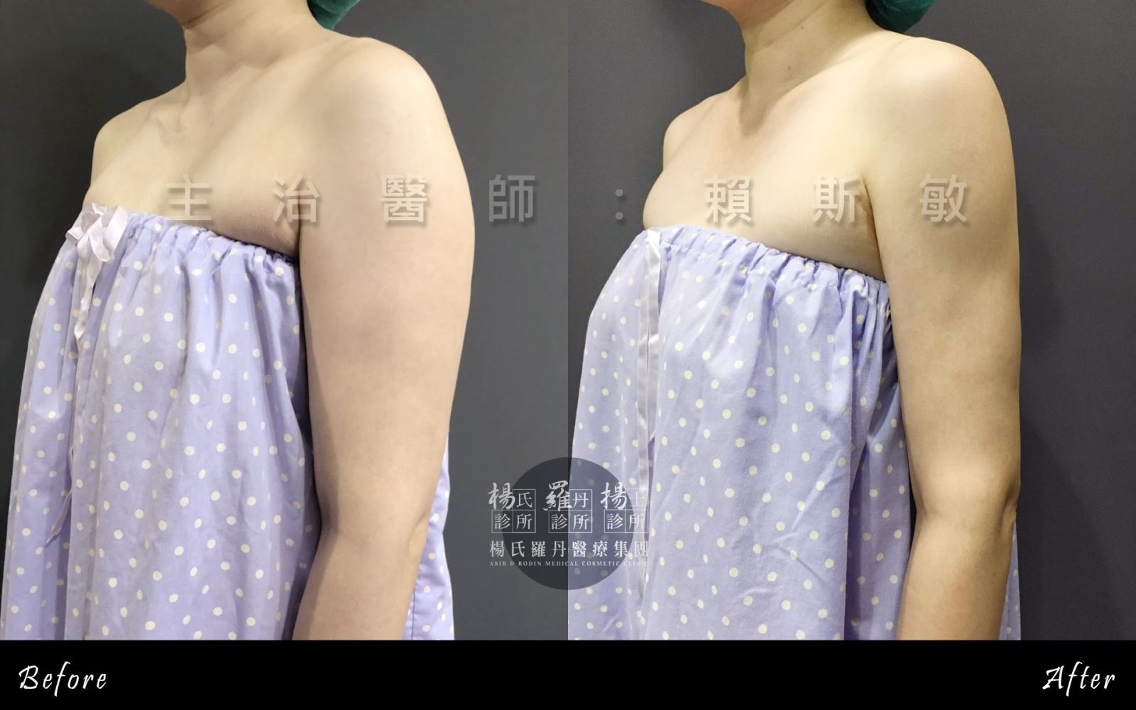 台北，雷射減脂(手臂抽脂)瘦手臂，術前術後照，賴斯敏醫師